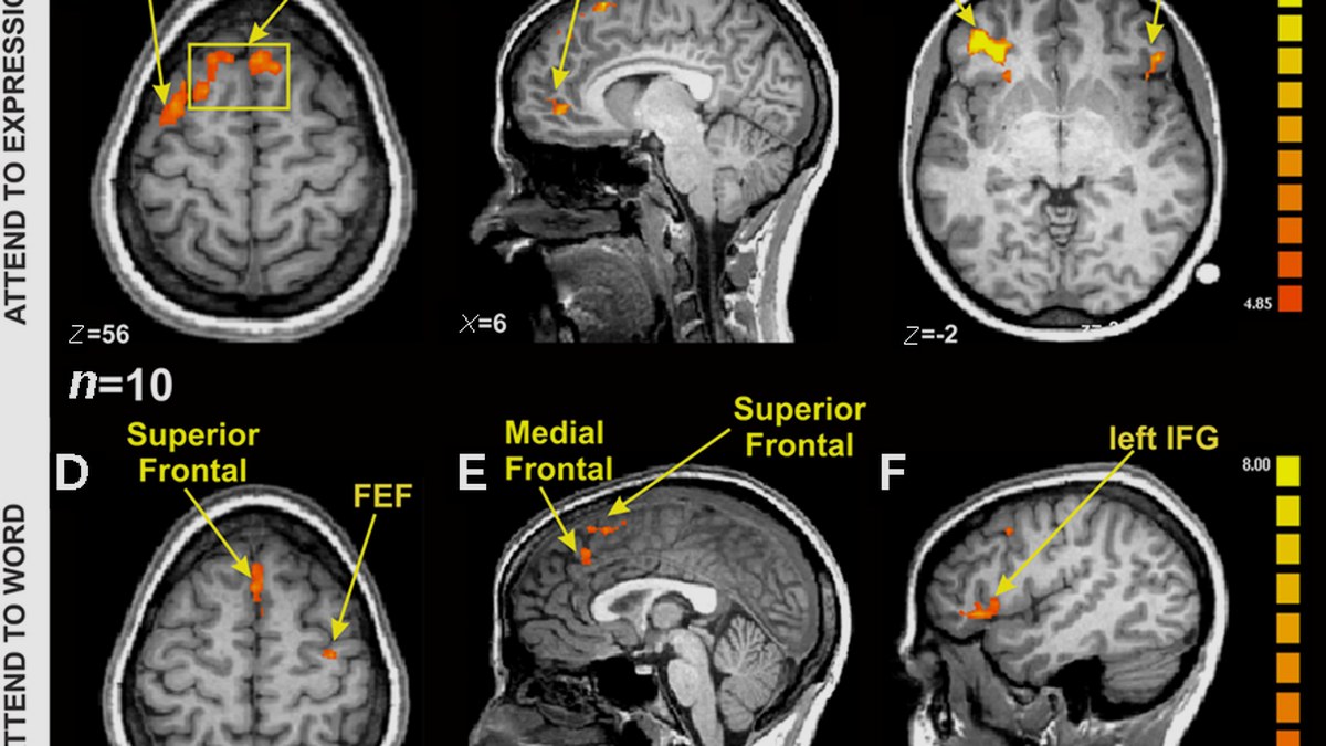 fMRI ile beyin aktivasyon haritası