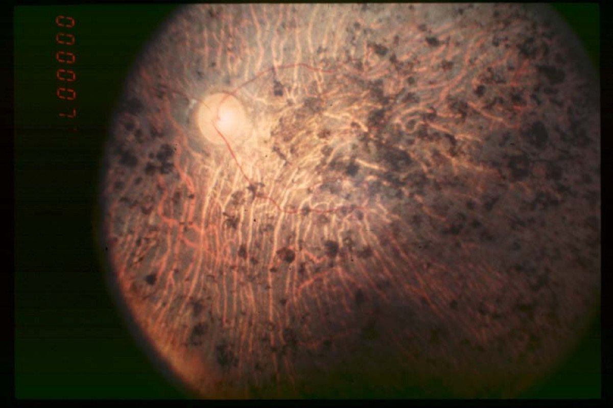 Son evre retinitis pigmentosada göz dibi fotoğrafı: incelmiş damarlar ve retinanın her yerine yayılmış koyu pigment birikintileri