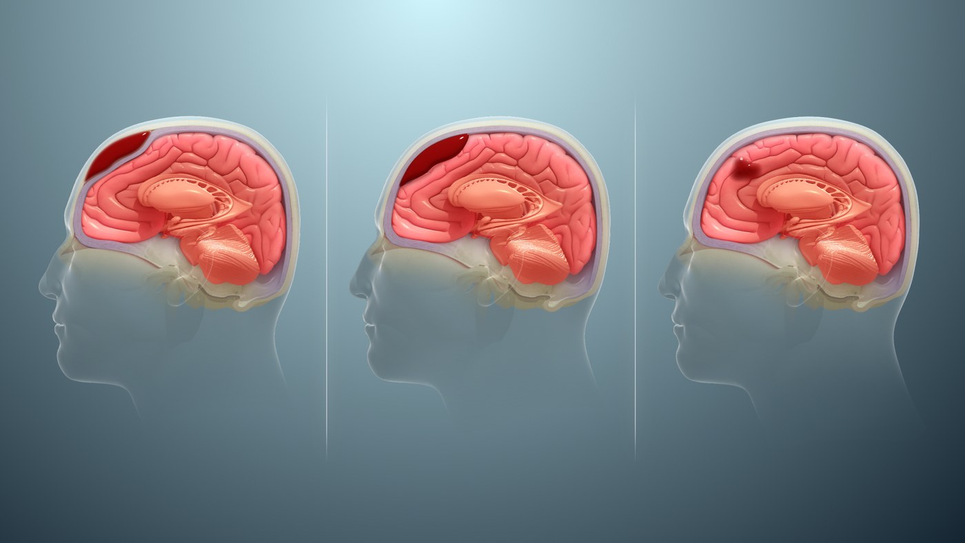 Kafatası içinde üç kanama tipi: epidural, subdural ve beyin içi hematom